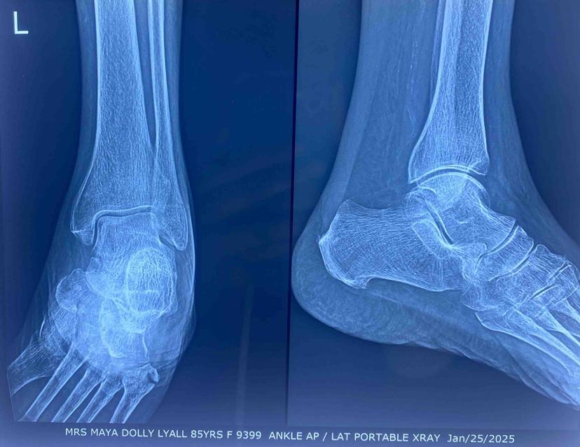 Ankle portable X-ray