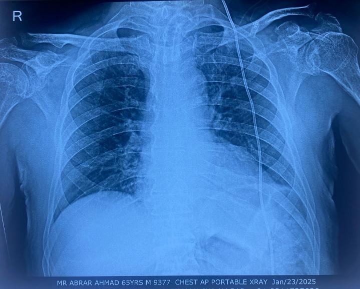 Chest AP portable X-ray