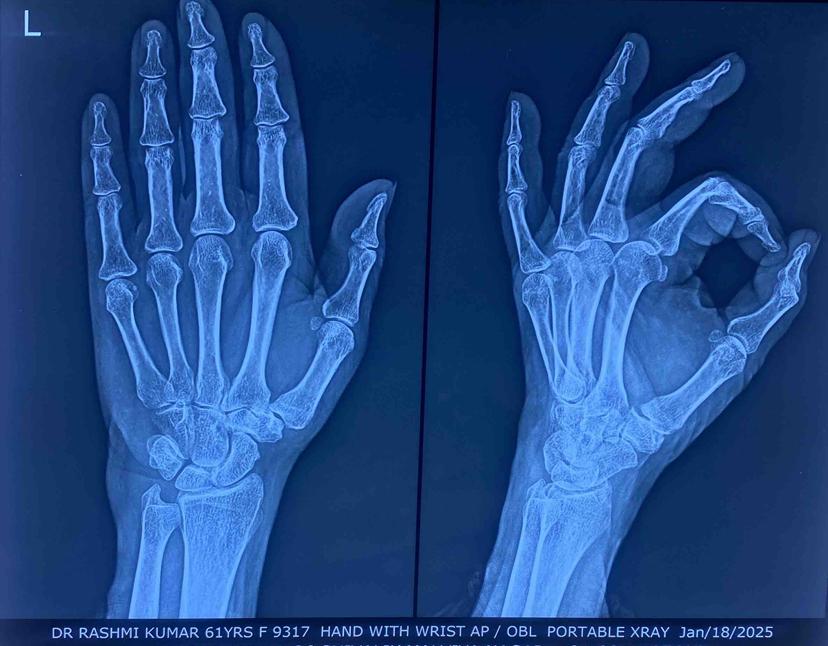 Hand with wrist portable X-ray