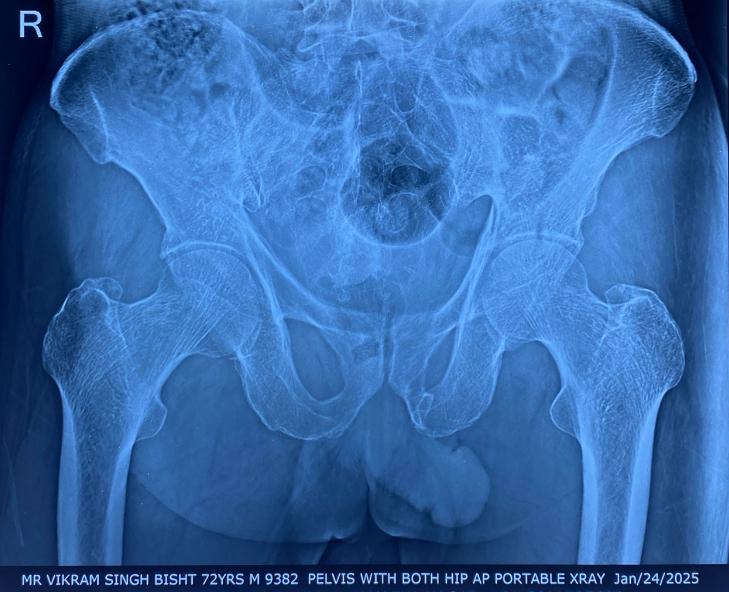 Pelvis with both hips portable X-ray