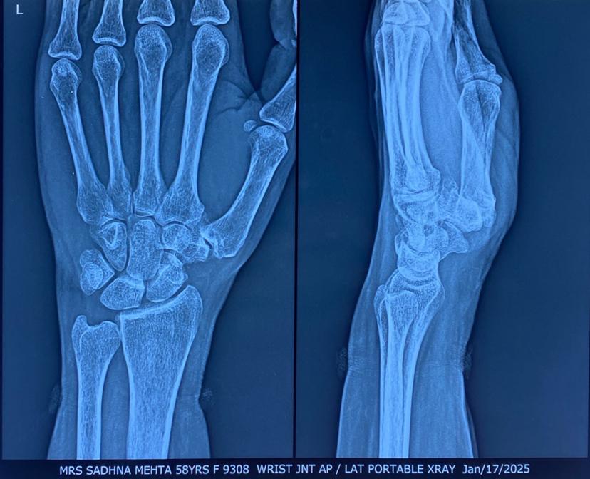 Wrist joint portable X-ray